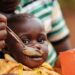 Repli de la malnutrition infantile au Bénin : Une condition sine qua non pour la capture du dividende démographique